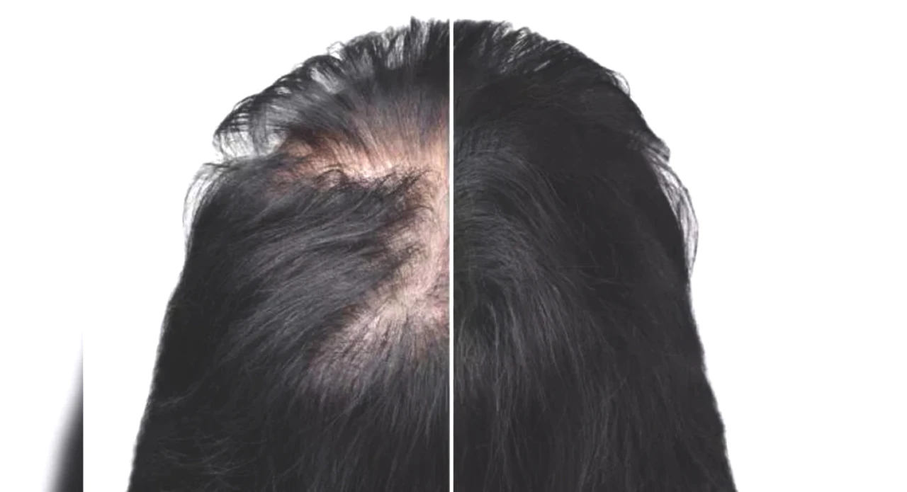 Discover the Top Treatments for Alopecia: Essential Insights You Must Know!